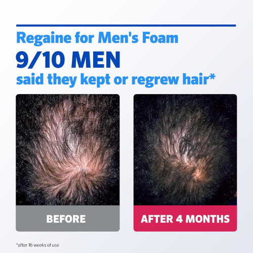 Extra‑Strength Hair Regrowth Foam – 3‑Month Supply (3 x 75 ml)
