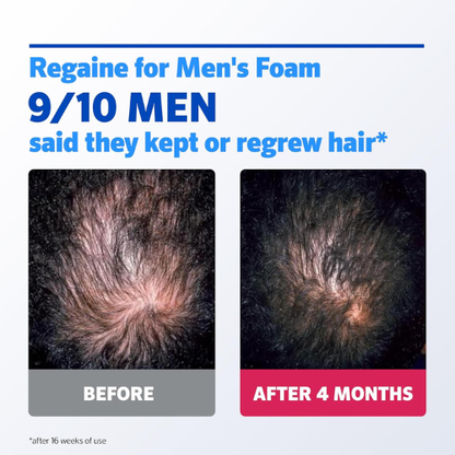 Extra‑Strength Hair Regrowth Foam – 3‑Month Supply (3 x 75 ml)
